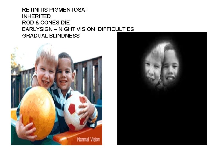 RETINITIS PIGMENTOSA: INHERITED ROD & CONES DIE EARLYSIGN – NIGHT VISION DIFFICULTIES GRADUAL BLINDNESS