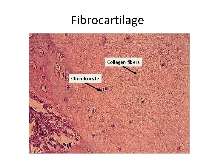 Fibrocartilage Collagen fibers Chondrocyte 