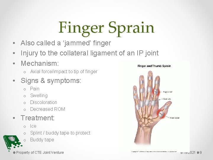 Finger Sprain • Also called a ‘jammed’ finger • Injury to the collateral ligament