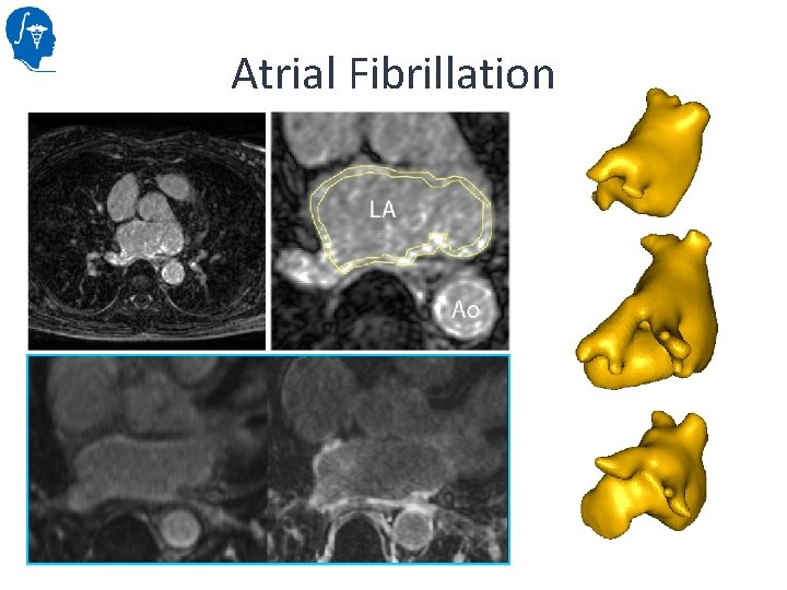 Atrial Fibrillation 