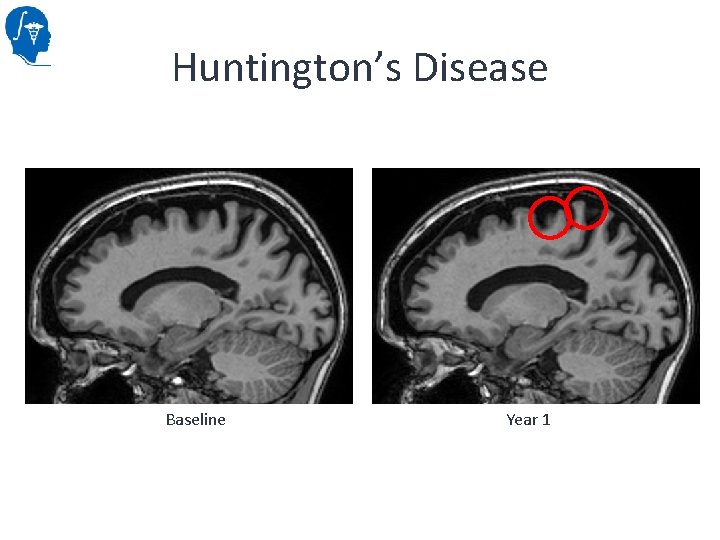 Huntington’s Disease Baseline Year 1 