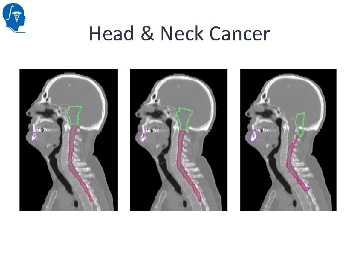 Head & Neck Cancer 