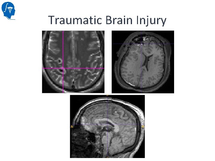 Traumatic Brain Injury 