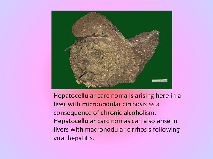 Hepatocellular carcinoma is arising here in a liver with micronodular cirrhosis as a consequence