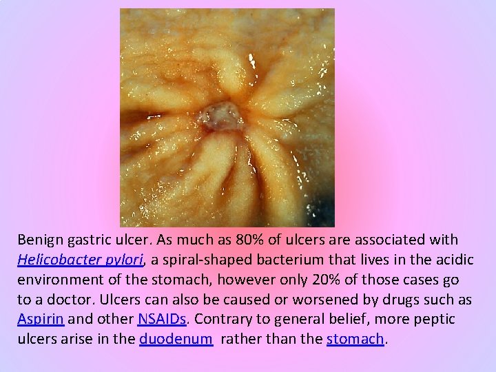 Benign gastric ulcer. As much as 80% of ulcers are associated with Helicobacter pylori,