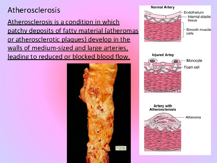 Atherosclerosis is a condition in which patchy deposits of fatty material (atheromas or atherosclerotic