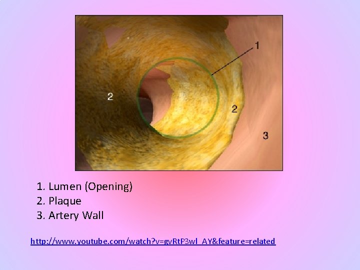 1. Lumen (Opening) 2. Plaque 3. Artery Wall http: //www. youtube. com/watch? v=gv. Rt.