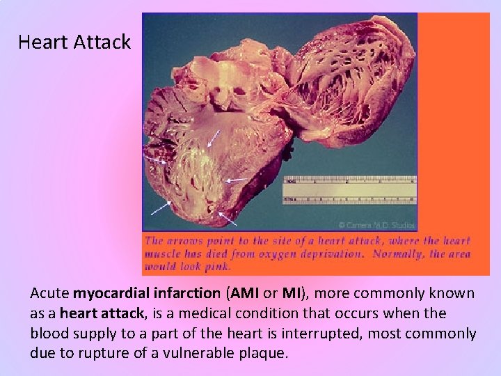 Heart Attack Acute myocardial infarction (AMI or MI), more commonly known as a heart