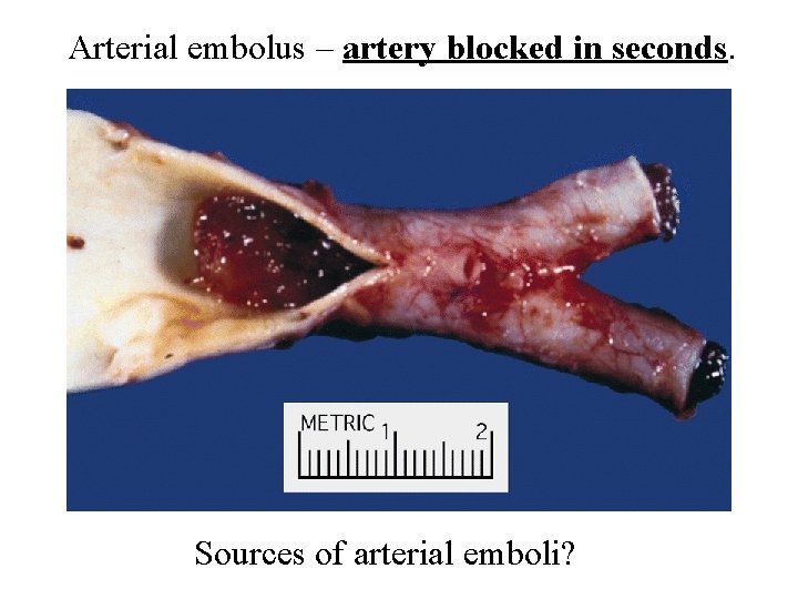 Arterial embolus – artery blocked in seconds. Sources of arterial emboli? 