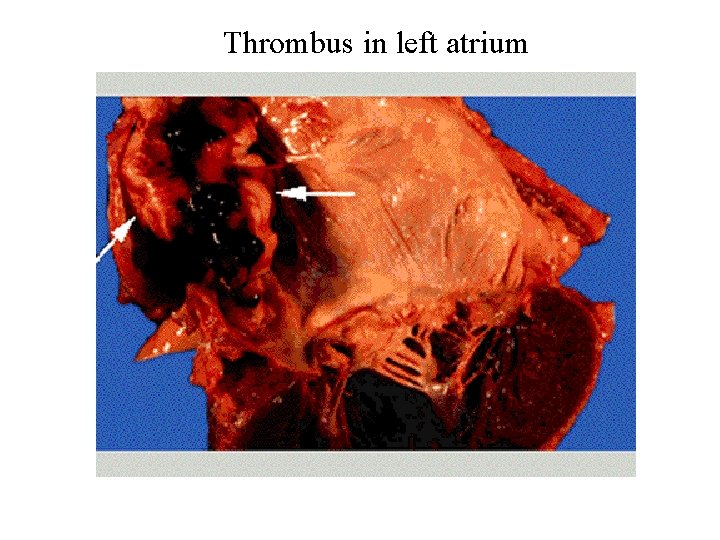 Thrombus in left atrium 