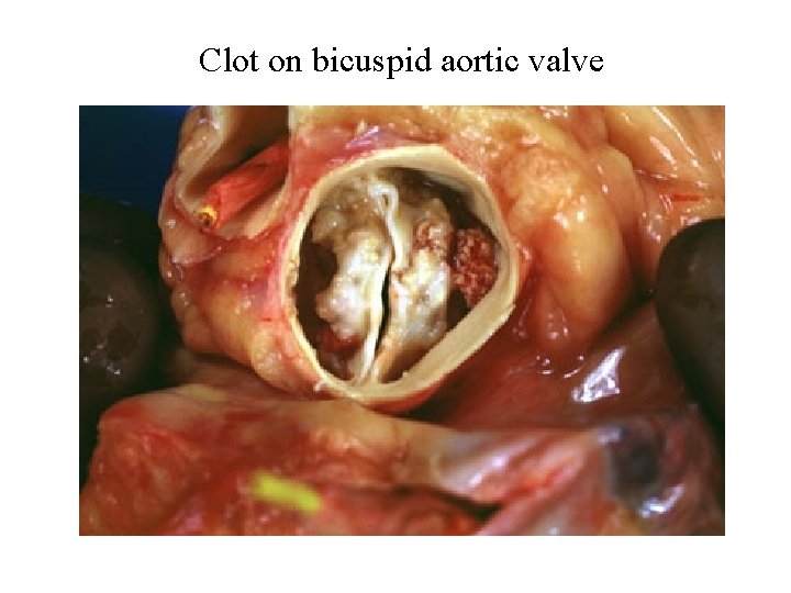 Clot on bicuspid aortic valve 
