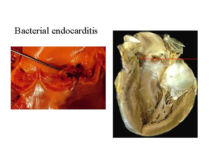 Bacterial endocarditis 