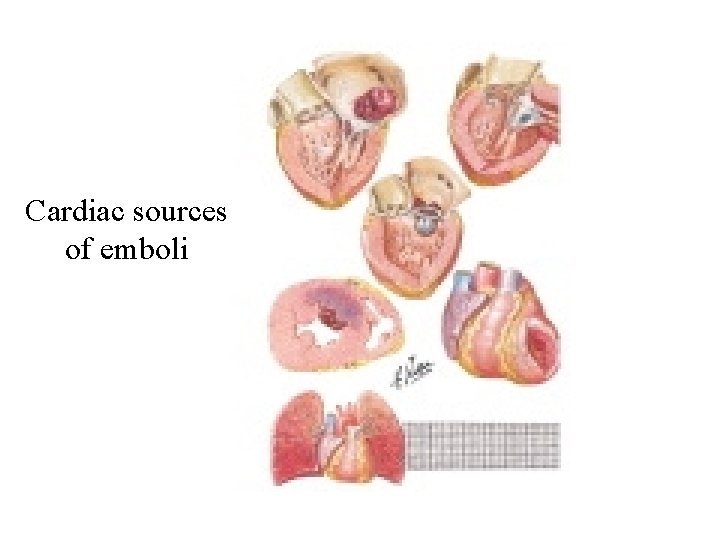 Cardiac sources of emboli 