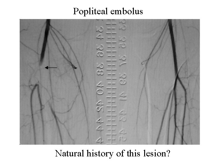Popliteal embolus Natural history of this lesion? 