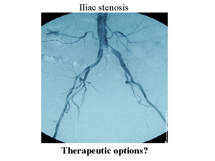 Iliac stenosis Therapeutic options? 