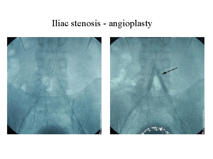 Iliac stenosis - angioplasty 