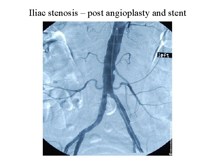 Iliac stenosis – post angioplasty and stent 