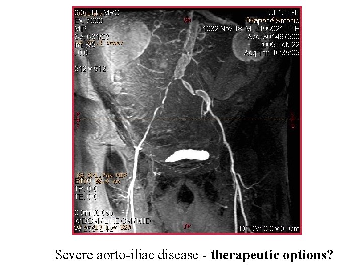 Severe aorto-iliac disease - therapeutic options? 
