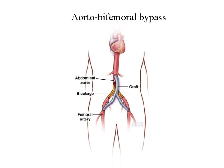 Aorto-bifemoral bypass 