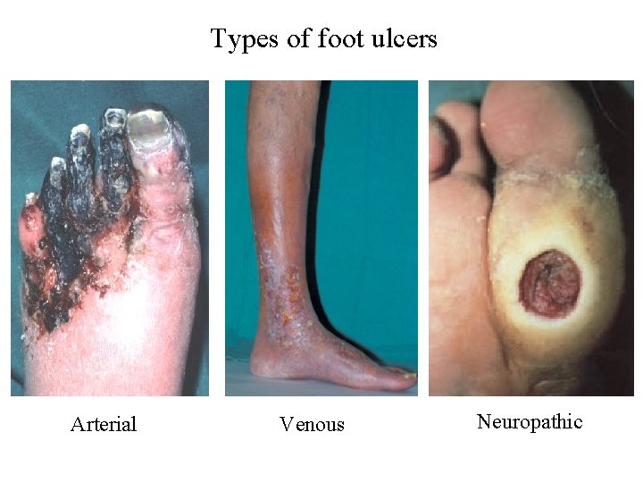 Types of foot ulcers Arterial Venous Neuropathic 