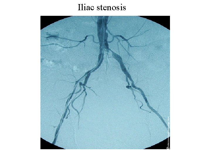 Iliac stenosis 