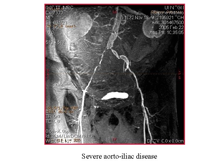 Severe aorto-iliac disease 