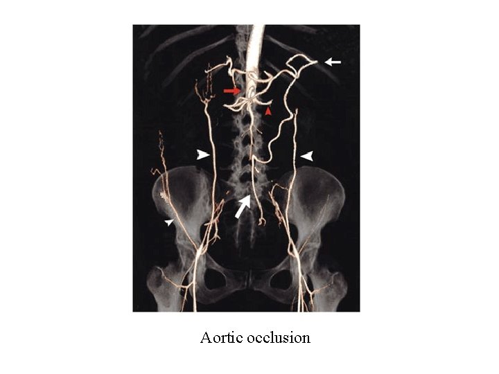 Aortic occlusion 