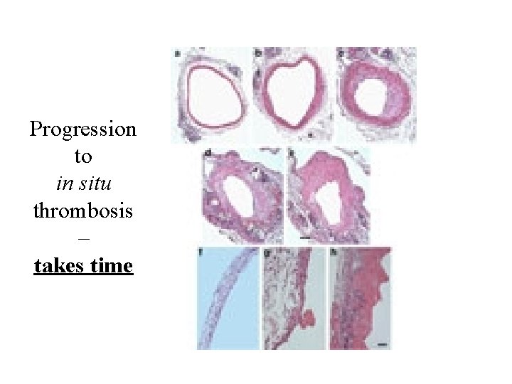 Progression to in situ thrombosis – takes time 