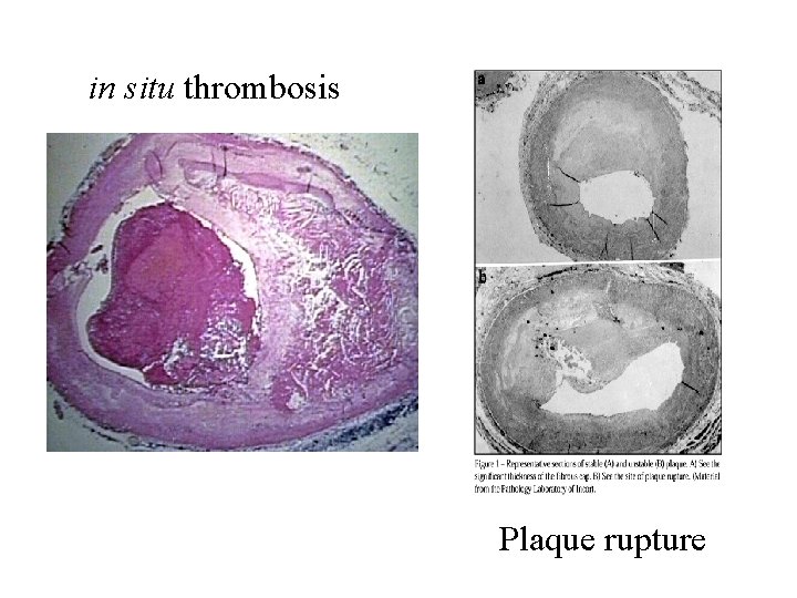 in situ thrombosis Plaque rupture 