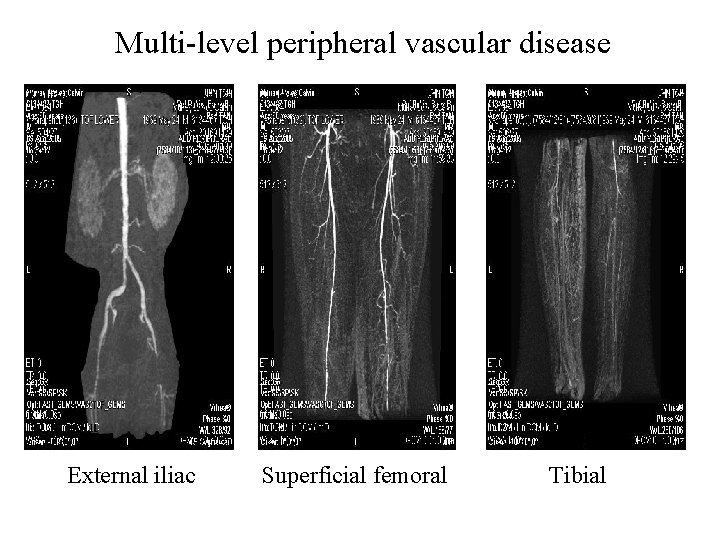 Multi-level peripheral vascular disease External iliac Superficial femoral Tibial 