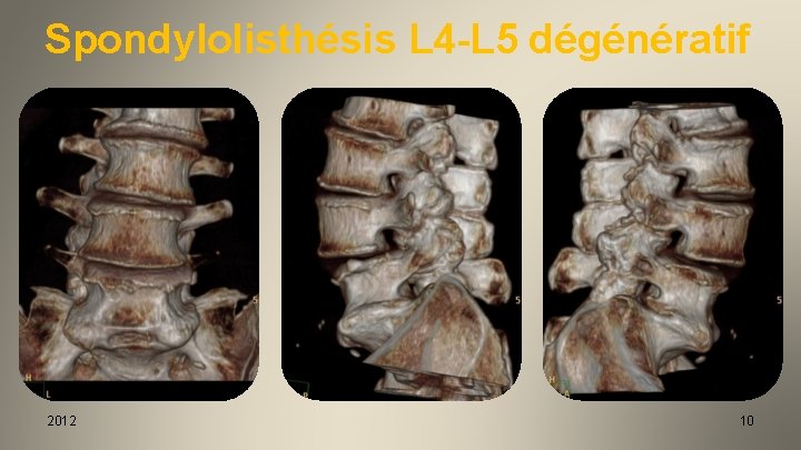 Spondylolisthésis L 4 -L 5 dégénératif 2012 10 