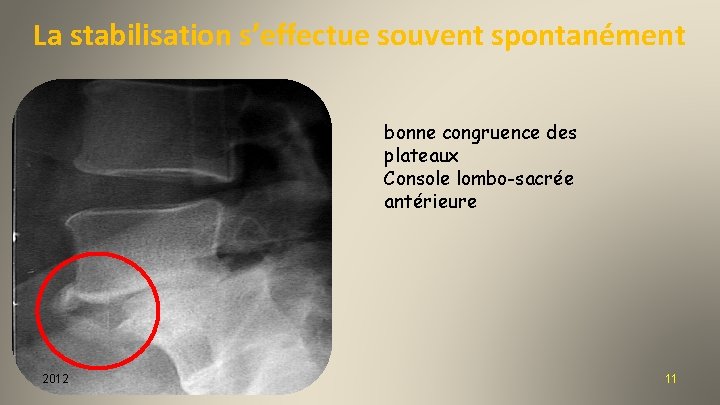 La stabilisation s’effectue souvent spontanément bonne congruence des plateaux Console lombo-sacrée antérieure 2012 11