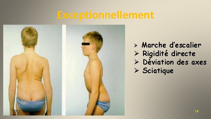 Exceptionnellement Marche d’escalier Ø Rigidité directe Ø Déviation des axes Ø Sciatique Ø 2012