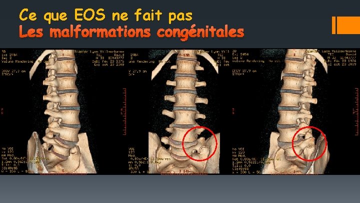 Ce que EOS ne fait pas Les malformations congénitales 