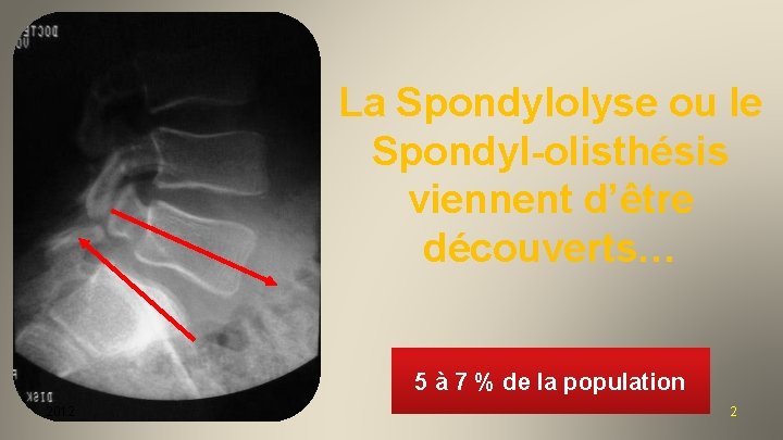 La Spondylolyse ou le Spondyl-olisthésis viennent d’être découverts… 5 à 7 % de la