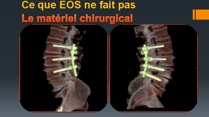 Ce que EOS ne fait pas Le matériel chirurgical 