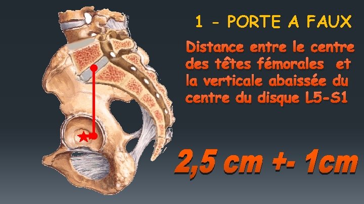 1 - PORTE A FAUX Distance entre le centre des têtes fémorales et la