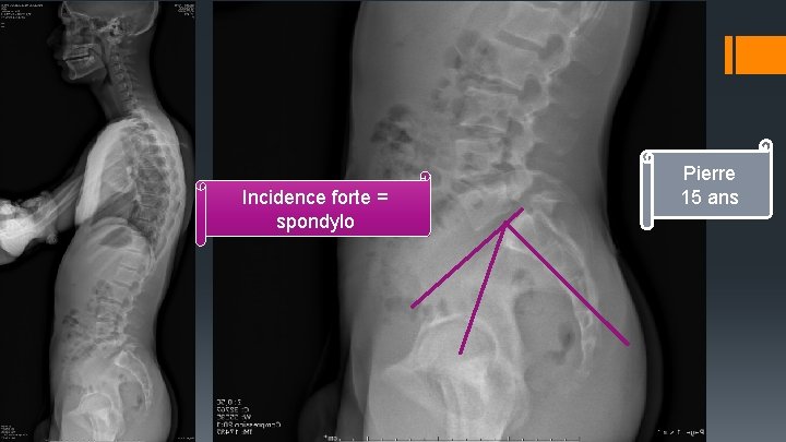 Incidence forte = spondylo Pierre 15 ans 