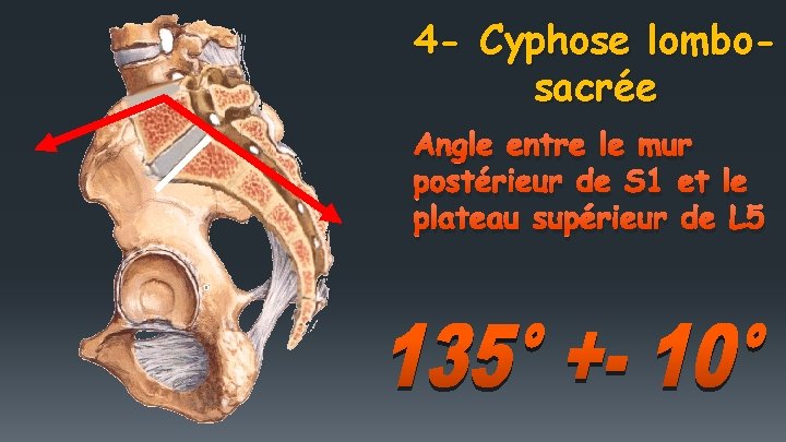 4 - Cyphose lombosacrée Angle entre le mur postérieur de S 1 et le