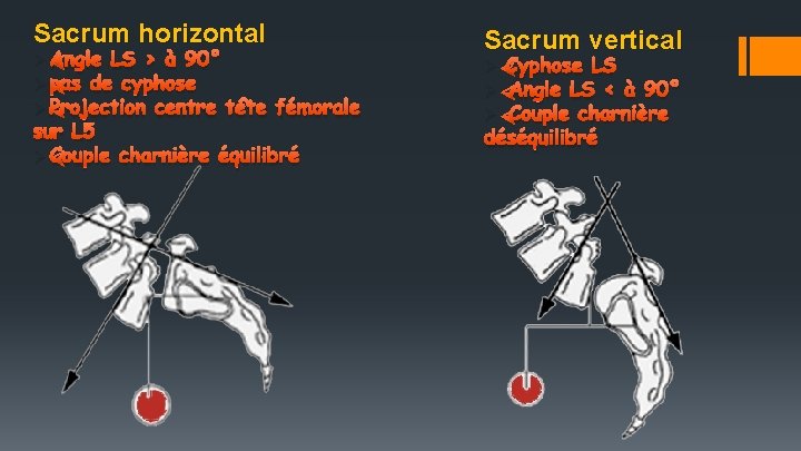 Sacrum horizontal ØAngle LS > à 90° Øpas de cyphose ØProjection centre tête fémorale