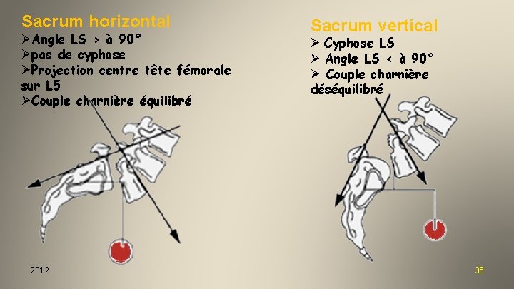 Sacrum horizontal ØAngle LS > à 90° Øpas de cyphose ØProjection centre tête fémorale