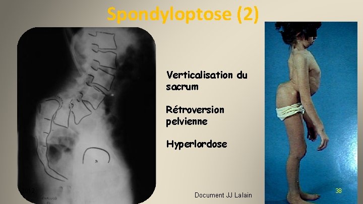 Spondyloptose (2) Verticalisation du sacrum Rétroversion pelvienne Hyperlordose 2012 Document JJ Lalain 38 