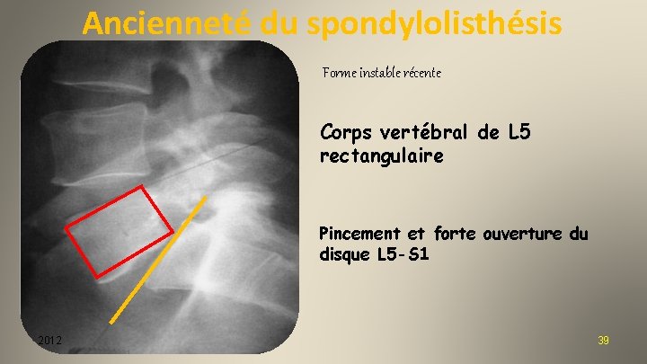 Ancienneté du spondylolisthésis Forme instable récente Corps vertébral de L 5 rectangulaire Pincement et