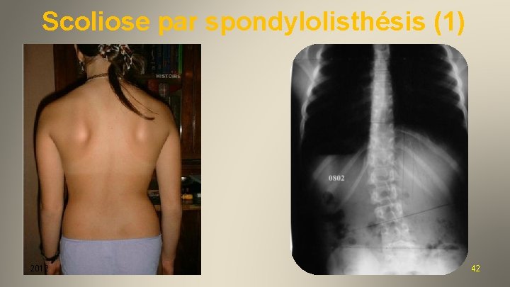 Scoliose par spondylolisthésis (1) 2012 42 