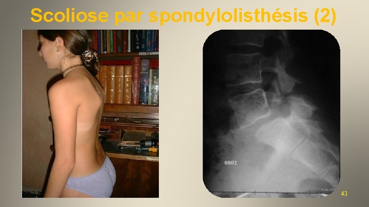 Scoliose par spondylolisthésis (2) 2012 43 