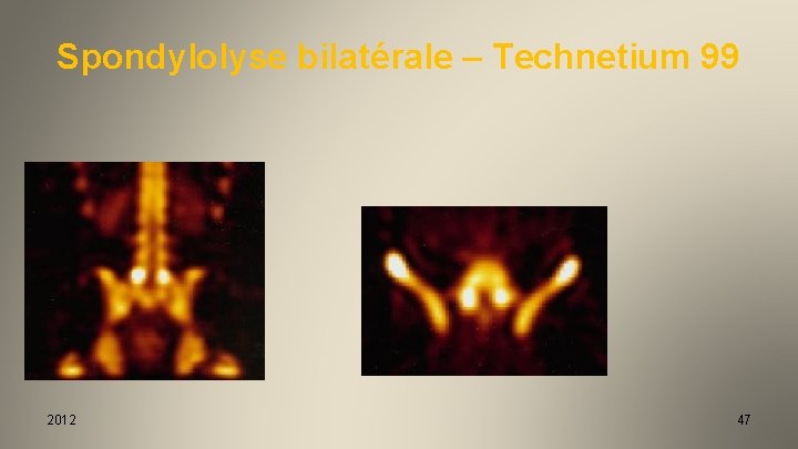 Spondylolyse bilatérale – Technetium 99 2012 47 