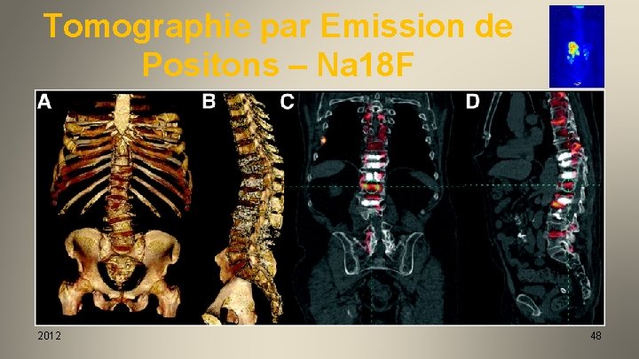 Tomographie par Emission de Positons – Na 18 F 2012 48 