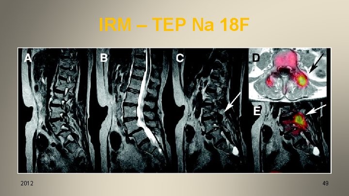 IRM – TEP Na 18 F 2012 49 