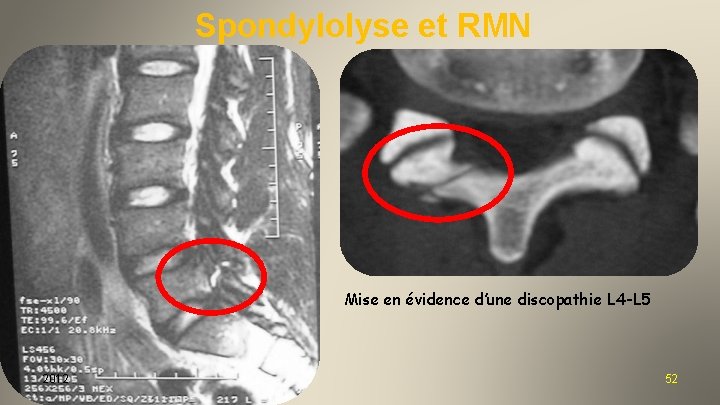 Spondylolyse et RMN Mise en évidence d’une discopathie L 4 -L 5 2012 52