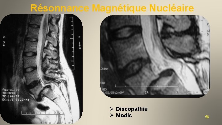 Résonnance Magnétique Nucléaire 2012 Ø Discopathie Ø Modic 56 